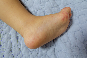 Hand Foot and Mouth disease