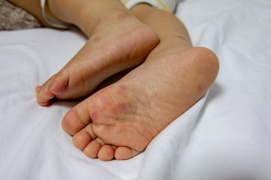 Hand Foot And Mouth Disease