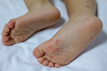 Hand Foot and Mouth disease