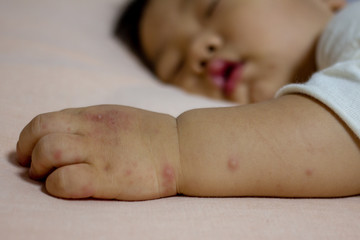 Hand Foot and Mouth disease - obrazy, fototapety, plakaty