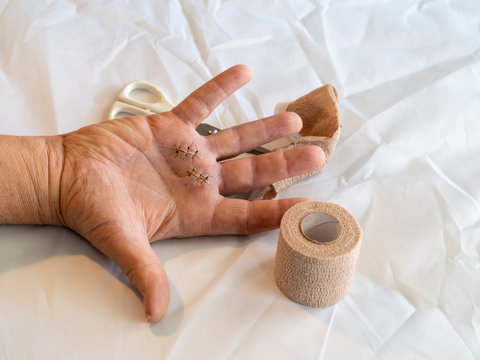 Male Hand With Stitches From A Recent Surgery With Scissors And Bandage Material