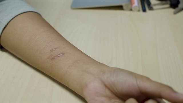 Person who tried to commit suicide by cuting her wrist seeks medical help from a doctor or psychiatrist - arm and scars visible
