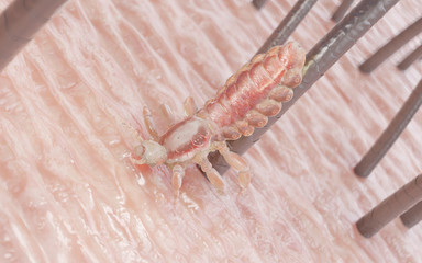 3d rendered illustration of a head louse on a human head