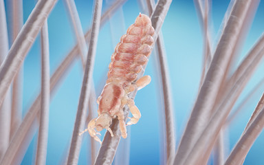 3d rendered illustration of a head louse on a human head