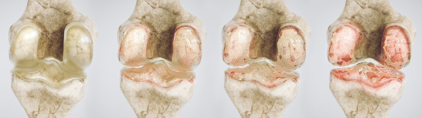 osteoarthritis of the knee in four stages - high degree of detail - 3D Rendering