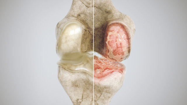healthy knee and osteoarthritis knee in comparison - high degree of detail - 3D Rendering