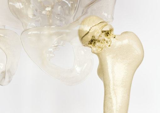 Severe osteoarthritis of the hip - 3D Rendering