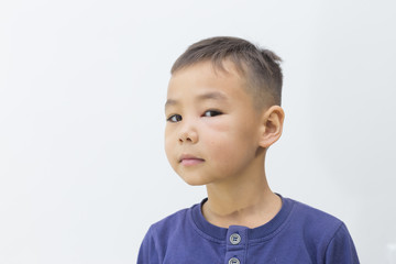 eye injury, boy with a puffy eye, isolated on white. after the fight with my brother.