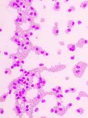 Picture of acute lymphocytic leukemia or ALL cells in blood smear, analyze by microscope, 400x