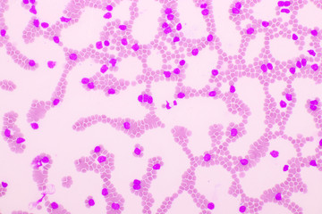Picture of acute lymphocytic leukemia or ALL cells in blood smear, analyze by microscope, 400x