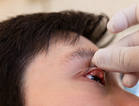 doctor use hand screening conjunctivitis patient, asian patient has red eyes and feeling pain, infection eye 