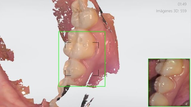 innovative 3D ultrasound of the teeth