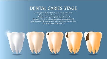 Dental caries stages vector medical poster banner template