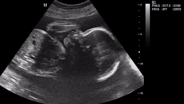 Ultrasound of pregnant woman in 6 month. Scientific analysis
