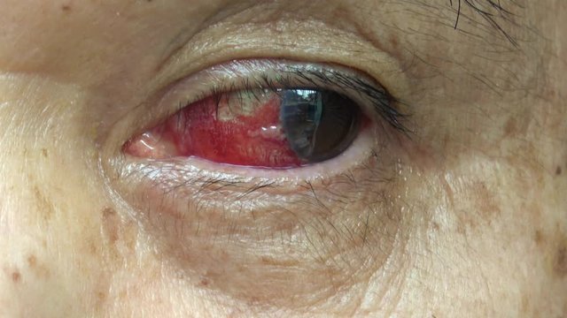 充血した目 白内障手術後 4K / Red bloodshot eye with a little scar from cataract surgery