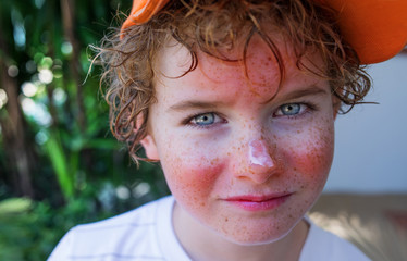 red painful skin, sunburn on the boy's face, sunburn protection need, close-up face of a cute caucasian boy with a sunscreen on his nose, which burned in the sun, freckles face