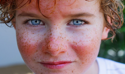 red painful skin, sunburn on the boy's face, sunburn protection need, close-up face of a cute caucasian boy with a sunscreen on his nose, which burned in the sun, freckles face