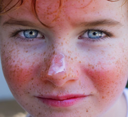 red painful skin, sunburn on the boy's face, sunburn protection need, close-up face of a cute caucasian boy with a sunscreen on his nose, which burned in the sun, freckles face