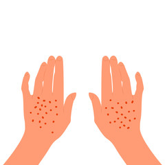 Red rash on the back of the female hands. Skin illness, allergy, inflammation.  Isolated on white background. Flat style stock vector.