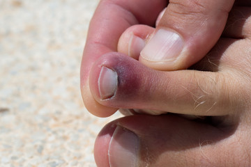 Soft focus close-up of a large bruise on a man's toe leg.