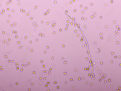 Picture of fungus and red blood cells in hemoculture tube, analyze by microscope 400x, specimen from HIV/AIDS patient