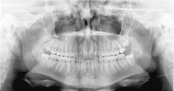 Panoramic x-ray of the jaw. X-ray picture of the girl's teeth