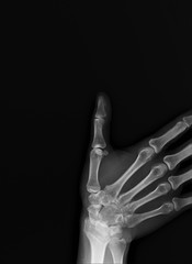 normal x-ray of the hand bones and fingers,orthopedics, medical diagnostics, rheumatology