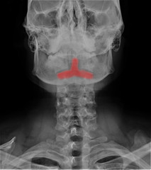 radiography of the cervical spine with a clearly visible tooth 2 cervical vertebra, traumatology, medical diagnostics