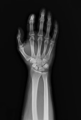 normal x-ray of the hand bones and fingers,orthopedics, medical diagnostics, rheumatology