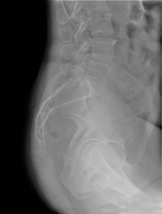 radiography of lumbar spine, sacrum, medical diagnosis