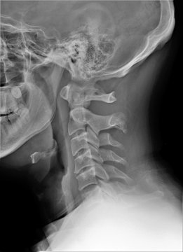 radiography of the cervical spine with a clearly visible tooth 2 cervical vertebra, traumatology, medical diagnostics