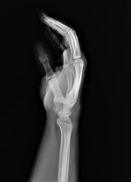 normal x-ray of the hand bones and fingers,orthopedics, medical diagnostics, rheumatology