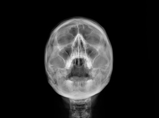 radiography of the paranasal sinuses of the skull, medical diagnosis