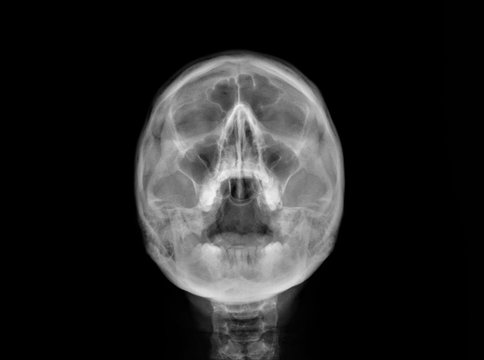 radiography of the paranasal sinuses of the skull, medical diagnosis