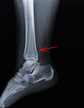 radiograph of the ankle joint in the lateral projection with a fracture of the outer ankle without displacement, traumatology, medical diagnostics