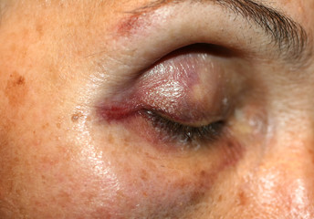 Obraz premium A bruise near the eye. Hematoma on the face from a blow. Eye injury.