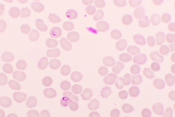 Malaria parasite in red blood cells, ring form stage of Plasmodium falciparum, original magnification 1000x