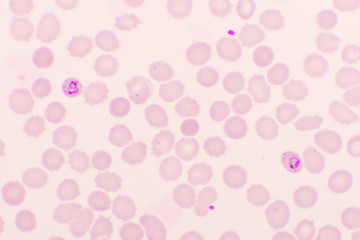 Malaria parasite in red blood cells, ring form stage of Plasmodium falciparum, original...