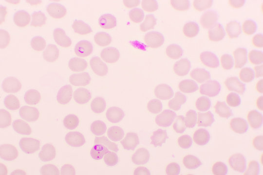 Malaria parasite in red blood cells, ring form stage of Plasmodium falciparum, original magnification 1000x