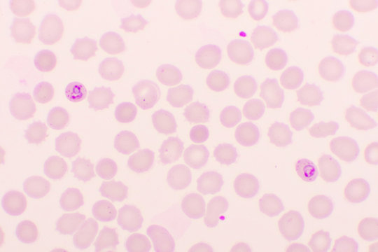 Malaria parasite in red blood cells, ring form stage of Plasmodium falciparum, original magnification 1000x