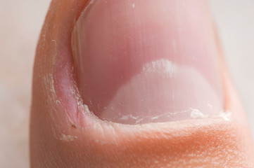Damaged skin on the finger, burrs, macro