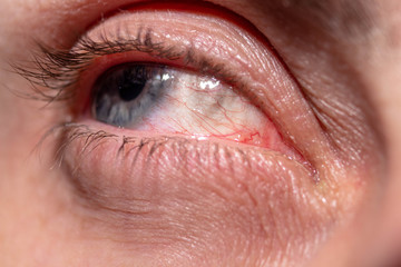 Obraz premium Red capillaries of an inflamed eye near
