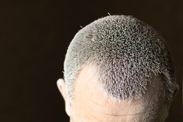 close-up. the man on the hair and skin is white plaque