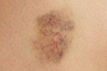 Close up on a bruise on wounded woman leg skin. Gender violence concept.