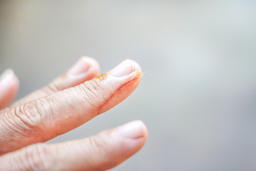 Woman left hand with wounds from cat bite on middle finger