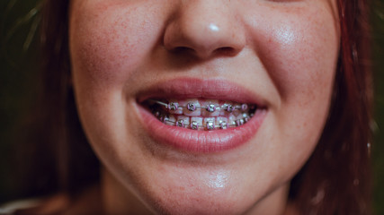 Fototapeta premium Dentistry concept. Smiling brunette girl with braces in her mouth.