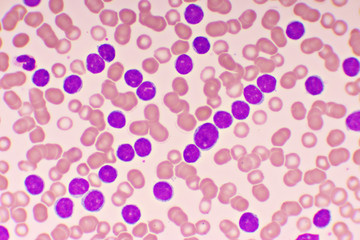 Blood picture of chronic lymphocytic leukemia or CLL, analyze by microscope, original magnification 1000x