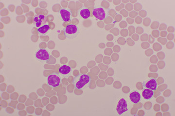 Fototapeta na wymiar Blood picture of chronic lymphocytic leukemia or CLL, analyze by microscope, original magnification 1000x