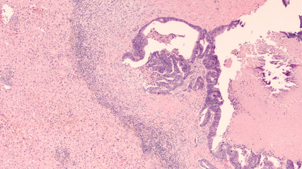 Micrograph of wedge biopsy from liver showing metastatic colon cancer. 