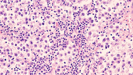 Testicular Cancer: Photomicrograph of seminoma, a malignant germ cell tumor of the testis (testicle).  It has a survival rate of 95%